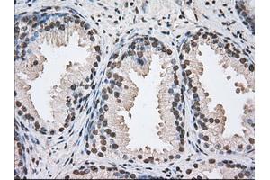 Immunohistochemical staining of paraffin-embedded Adenocarcinoma of Human ovary tissue using anti-BAT1 mouse monoclonal antibody. (BAT1 antibody)