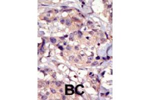 Formalin-fixed and paraffin-embedded human cancer tissue reacted with PDGFRA polyclonal antibody  , which was peroxidase-conjugated to the secondary antibody, followed by DAB staining. (PDGFRA antibody  (C-Term))