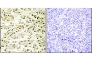 Immunohistochemistry analysis of paraffin-embedded human pancreas tissue, using RAD51L1 Antibody. (RAD51 Homolog B antibody  (AA 201-250))