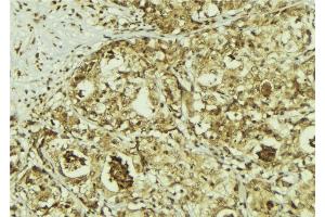 ABIN6267214 at 1/100 staining Human breast cancer tissue by IHC-P.