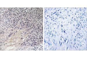 Peptide - +Immunohistochemistry analysis of paraffin-embedded human cervix carcinoma tissue using ARHGDIA antibody. (ARHGDIA antibody  (Internal Region))