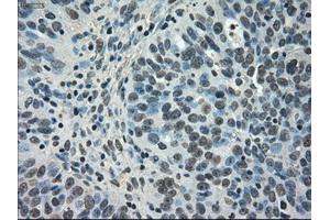 Immunohistochemical staining of paraffin-embedded Carcinoma of kidney tissue using anti-NEK6mouse monoclonal antibody. (NEK6 antibody)
