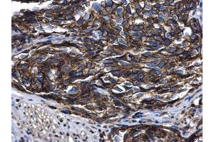 IHC-P Image ARFIP2 antibody [N1C2] detects ARFIP2 protein at cytoplasm in human cervical cancer by immunohistochemical analysis. (ARFIP2 antibody)