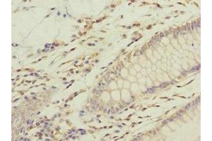 Immunohistochemistry of paraffin-embedded human colon cancer using ABIN7168218 at dilution of 1:100 (GFM2 antibody  (AA 520-779))