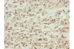 Immunohistochemistry of paraffin-embedded human glioma using ABIN7159294 at dilution of 1:100