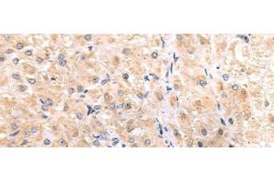 Immunohistochemistry of paraffin-embedded Human liver cancer tissue using ITGA3 Polyclonal Antibody at dilution of 1:45(x200) (ITGA3 antibody)