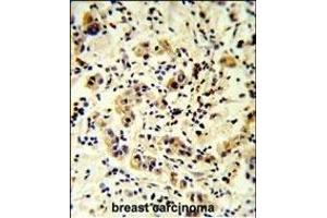 CC50B Antibody (N-term) (ABIN651159 and ABIN2840104) IHC analysis in formalin fixed and paraffin embedded human breast carcinoma followed by peroxidase conjugation of the secondary antibody and DAB staining. (TMEM30B antibody  (N-Term))