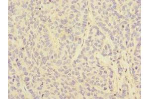 Immunohistochemistry of paraffin-embedded human ovarian cancer using ABIN7158546 at dilution of 1:100 (FCGR2C antibody  (AA 43-223))