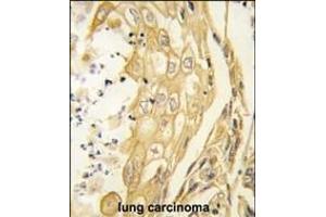 Formalin-fixed and paraffin-embedded human lung carcinoma tissue reacted with the EphB4 antibody (ABIN391924 and ABIN2841734) , which was peroxidase-conjugated to the secondary antibody, followed by DAB staining.