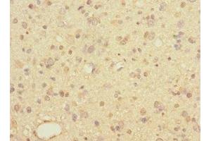 Immunohistochemistry of paraffin-embedded human glioma using ABIN7158053 at dilution of 1:100 (LINGO1 antibody  (AA 42-240))