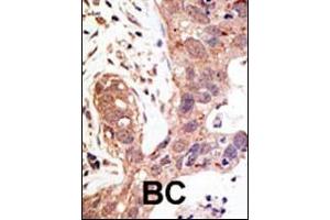 Formalin-fixed and paraffin-embedded human cancer tissue reacted with the primary antibody, which was peroxidase-conjugated to the secondary antibody, followed by AEC staining. (SENP1 antibody  (N-Term))