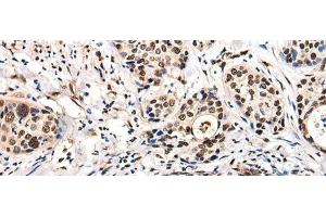 Immunohistochemistry of paraffin-embedded Human cervical cancer tissue using USP6NL Polyclonal Antibody at dilution of 1:30(x200) (USP6NL antibody)