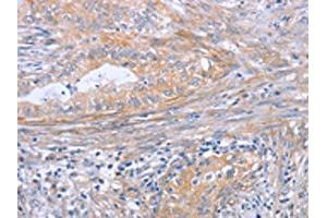 The image on the left is immunohistochemistry of paraffin-embedded Human cervical cancer tissue using ABIN7189998(BOD1 Antibody) at dilution 1/30, on the right is treated with synthetic peptide.