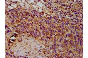 IHC image of ABIN7151818 diluted at 1:300 and staining in paraffin-embedded human ovarian cancer performed on a Leica BondTM system. (EPX antibody  (AA 140-300))