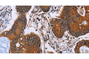 Immunohistochemistry of paraffin-embedded Human colon cancer tissue using IHH Polyclonal Antibody at dilution 1:30 (Indian Hedgehog antibody)