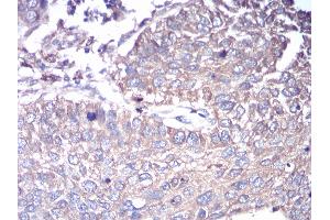Immunohistochemical analysis of paraffin-embedded lung cancer tissues using GNAS mouse mAb with DAB staining.