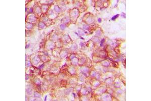 Immunohistochemical analysis of CRK staining in human breast cancer formalin fixed paraffin embedded tissue section.