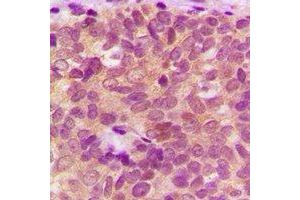 Immunohistochemical analysis of IDE staining in human breast cancer formalin fixed paraffin embedded tissue section. (IDE antibody)
