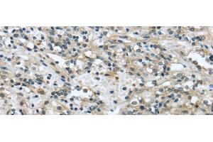 Immunohistochemistry of paraffin-embedded Human prostate cancer tissue using VPS4A Polyclonal Antibody at dilution 1:40 (VPS4A antibody)