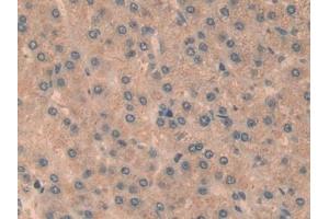 Detection of RELB in Human Liver cancer Tissue using Polyclonal Antibody to V-Rel Reticuloendotheliosis Viral Oncogene Homolog B (RELB) (RELB antibody  (AA 248-492))