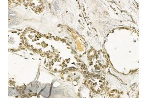 G3BP-1 Mouse Monoclonal Antibody at 1/100 staining human ovarian cancer by IHC-P.