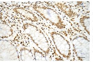 Immunohistochemistry was performed on paraffin-embedded human sigmoid colon carcinoma using histone H3 (mono methyl K79) antibody (ABIN7798961), 1:200). (Recombinant Histone 3 antibody  (H3K79me1))