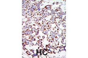 Formalin-fixed and paraffin-embedded human hepatocellular carcinoma tissue reacted with the MAP3K7 polyclonal antibody , which was peroxidase-conjugated to the secondary antibody, followed by AEC staining. (MAP3K7 antibody  (C-Term))