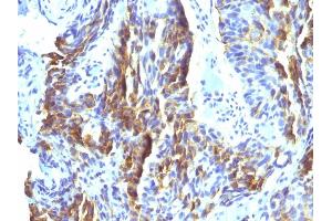 Formalin-fixed, paraffin-embedded human Tongue stained with Melanoma Monoclonal Antibody (KBA. (Melanoma Associated Antigen (KBA.62) antibody)