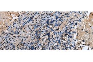 Immunohistochemistry of paraffin-embedded Human lung cancer tissue using ABHD14B Polyclonal Antibody at dilution of 1:30(x200) (ABHD14B antibody)