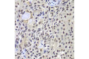 Immunohistochemistry of paraffin-embedded human well-differentiated squamous skin carcinoma using PRKDC antibody at dilution of 1:100 (x400 lens). (PRKDC antibody)