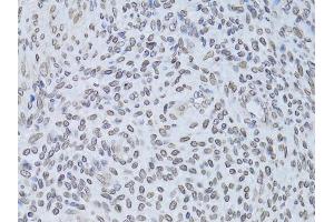 Immunohistochemistry of paraffin-embedded human adenomyosis using LMNB2 Antibody (ABIN5973877) at dilution of 1/100 (40x lens). (Lamin B2 antibody)