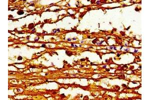 Immunohistochemistry of paraffin-embedded human melanoma using ABIN7163123 at dilution of 1:100 (ABCB4 antibody  (AA 530-693))