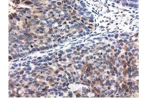 Immunohistochemical staining of paraffin-embedded Carcinoma of Human kidney tissue using anti-QPRT mouse monoclonal antibody.