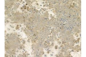 ABIN6257016 and ABIN6274443 at 1/100 staining human melanoma by IHC-P. (EPS8-Like 1 antibody  (Internal Region))