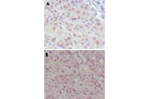 Immunohistochemical analysis of paraffin-embedded human lung cancer (A) and esophagus cancer (B), showing nuclear weak staining with DAB staining using MLL monoclonal antibody, clone 10F8D7 . (MLL/KMT2A antibody)