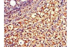 Immunohistochemistry of paraffin-embedded human ovarian cancer using ABIN7149920 at dilution of 1:100 (QDPR antibody  (AA 2-244))