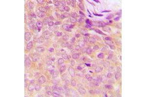 Immunohistochemical analysis of UBA5 staining in human breast cancer formalin fixed paraffin embedded tissue section. (UBA5 antibody  (C-Term))
