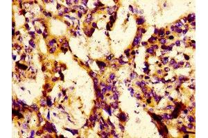 Immunohistochemistry of paraffin-embedded human gastric cancer using ABIN7158434 at dilution of 1:100 (LBP antibody  (AA 304-414))