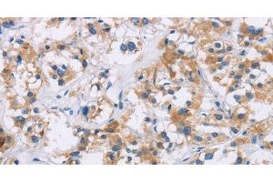 Immunohistochemistry of paraffin-embedded Human thyroid cancer tissue using IAPP Polyclonal Antibody at dilution 1:40 (Amylin/DAP antibody)