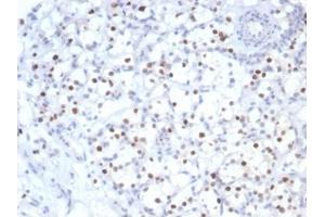 IHC analysis of formalin-fixed, paraffin-embedded human kidney cancer. (Recombinant CDKN1C antibody)