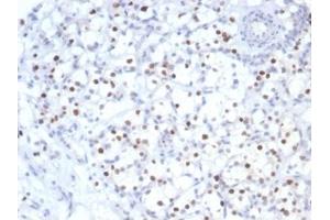 IHC analysis of formalin-fixed, paraffin-embedded human kidney cancer.