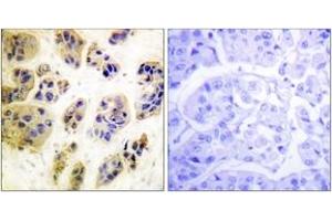 Immunohistochemistry analysis of paraffin-embedded human breast carcinoma, using CBL (Phospho-Tyr700) Antibody. (CBL antibody  (pTyr700))