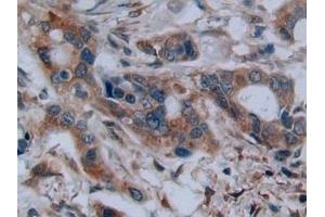 Detection of C2CD3 in Human Pancreatic cancer Tissue using Polyclonal Antibody to C2 Calcium Dependent Domain Containing Protein 3 (C2CD3) (C2CD3 antibody  (AA 1432-1647))