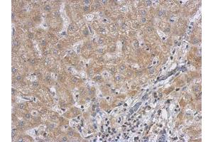 IHC-P Image Immunohistochemical analysis of paraffin-embedded human hepatoma, using RACGAP1, antibody at 1:500 dilution. (RACGAP1 antibody  (N-Term))