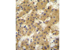 APOF antibody immunohistochemistry analysis in formalin fixed and paraffin embedded human hepatocarcinoma followed by peroxidase conjugation of the secondary antibody and DAB staining. (Apolipoprotein F antibody  (AA 111-138))