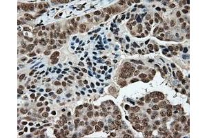 Immunohistochemical staining of paraffin-embedded Adenocarcinoma of colon tissue using anti-MCL1 mouse monoclonal antibody. (MCL-1 antibody)