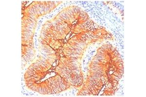 IHC staining of human colon cancer with TAG-72 antibody (TAG-72 antibody)