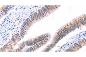 Immunohistochemistry of paraffin-embedded Human colon cancer tissue using VWF Polyclonal Antibody at dilution 1:50 (VWF antibody)