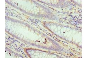 Immunohistochemistry of paraffin-embedded human colon cancer using ABIN7150176 at dilution of 1:100 (DFFA antibody  (AA 1-331))