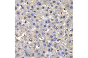 Immunohistochemistry of paraffin-embedded human liver injury using DHFR antibody at dilution of 1:100 (400x lens).